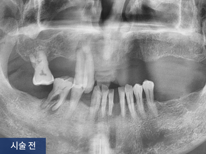 전악 임플란트 사례