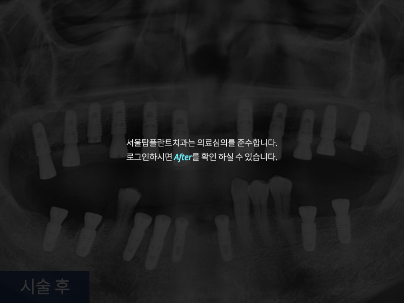 전악 임플란트 사례