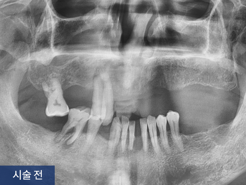 전악 임플란트 사례