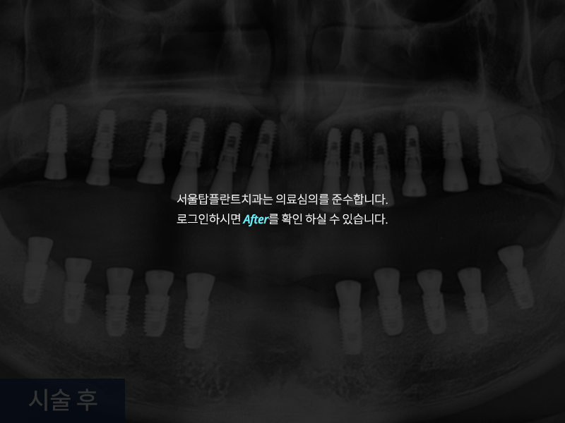 전악 임플란트 사례