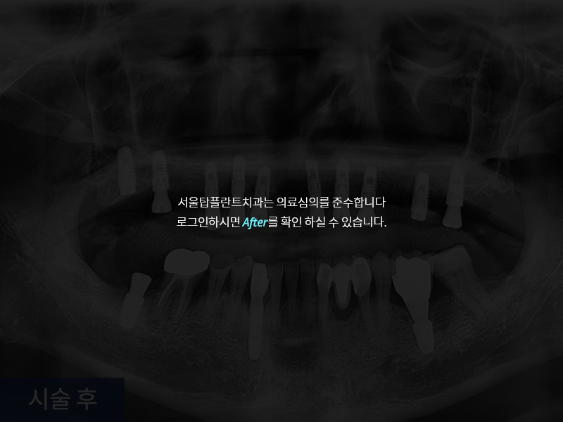 상악 임플란트 사례