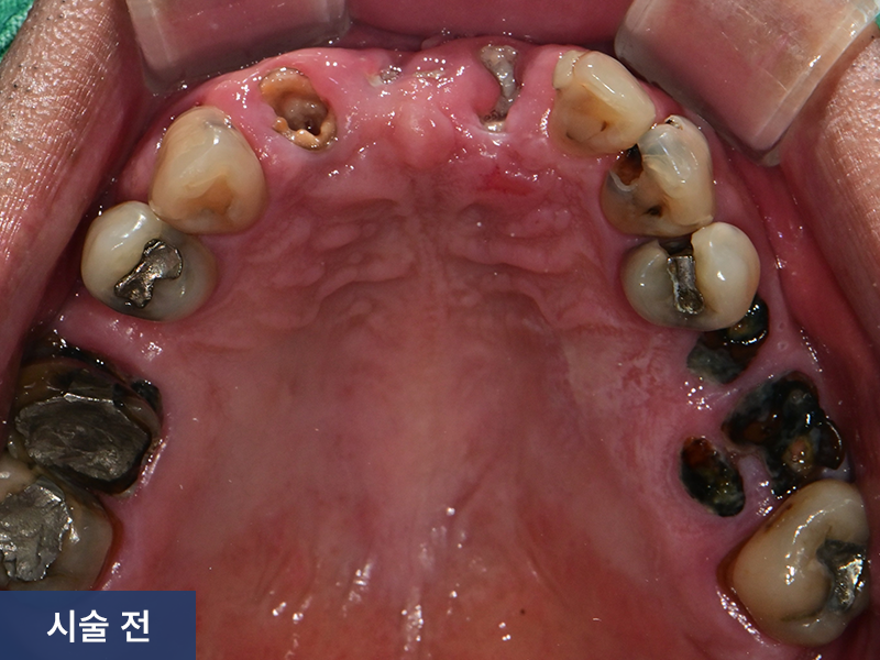 임플란트 사례 1