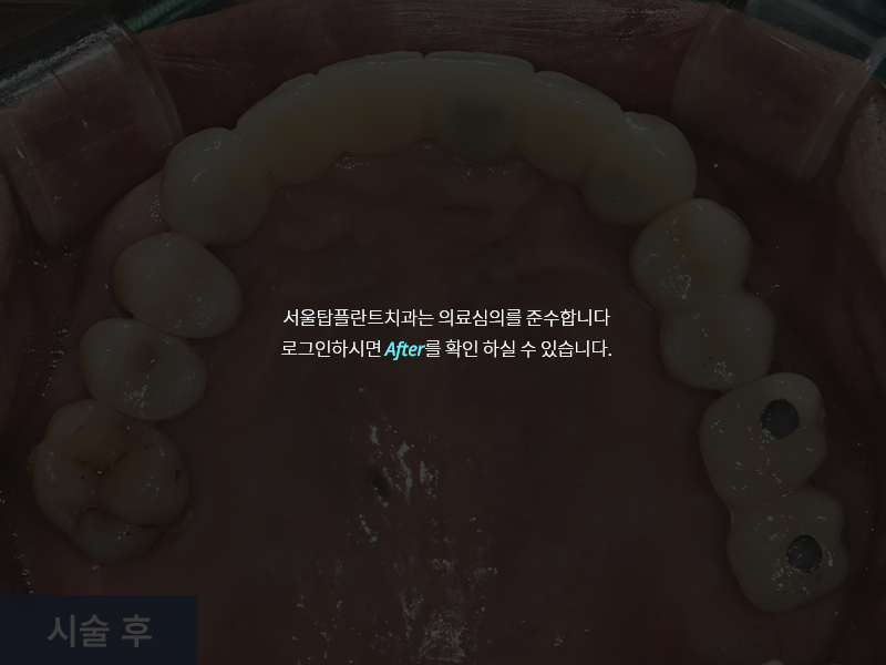 임플란트 사례 2