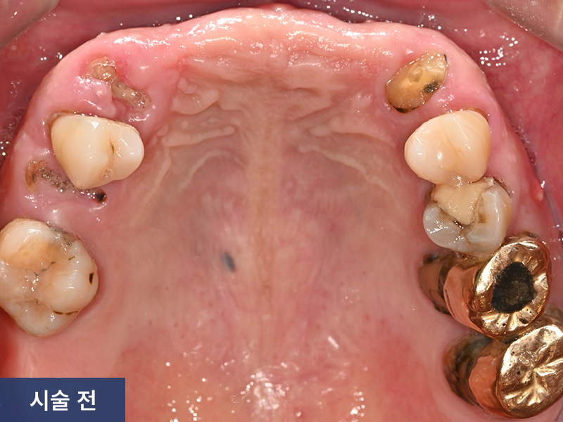 임플란트 사례 2