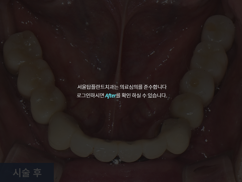 임플란트 사례 3