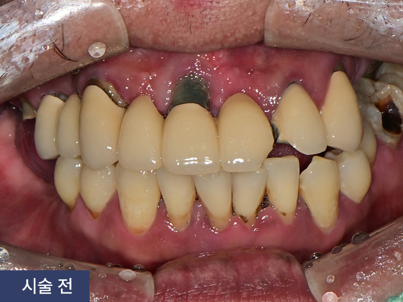 임플란트 사례 3