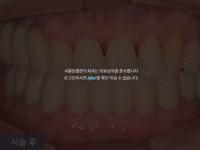 임플란트 사례 3
