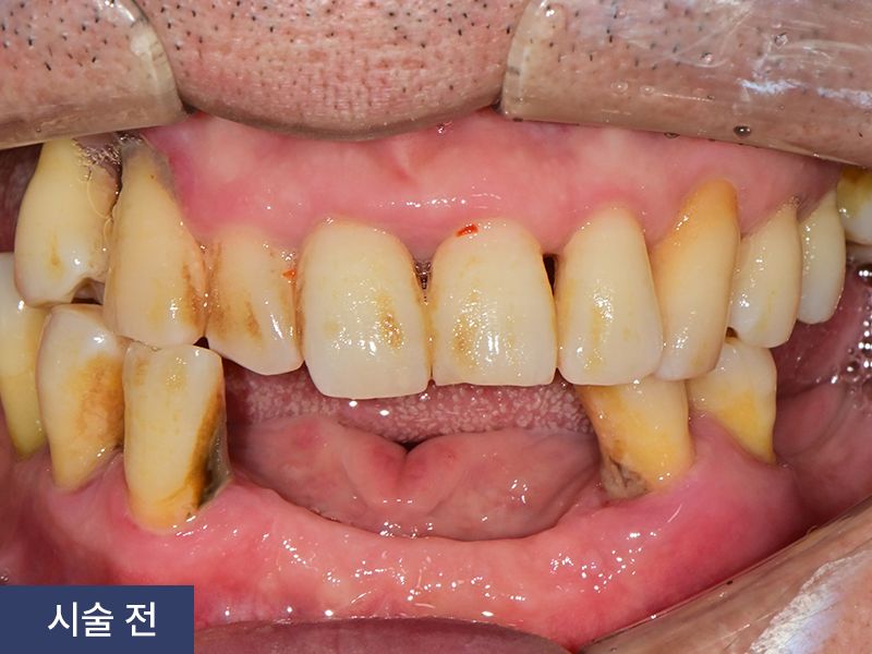 임플란트 사례 3
