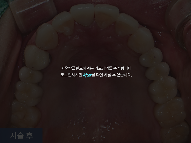 보철치료 사례 1