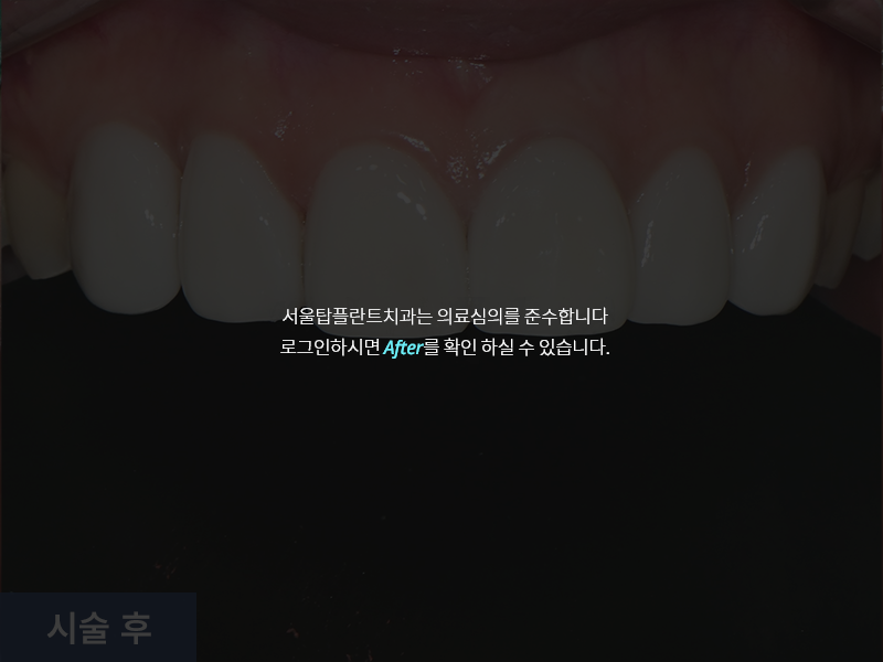 보철치료 사례 2