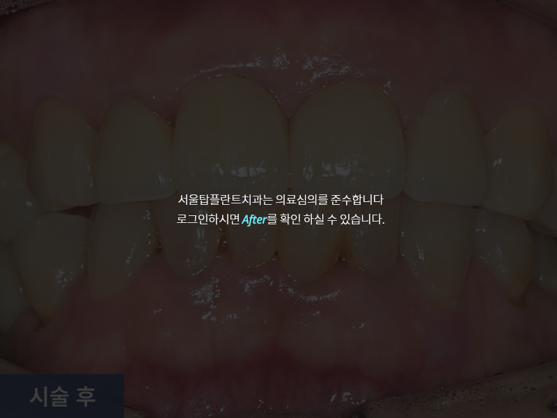 보철치료 사례 3