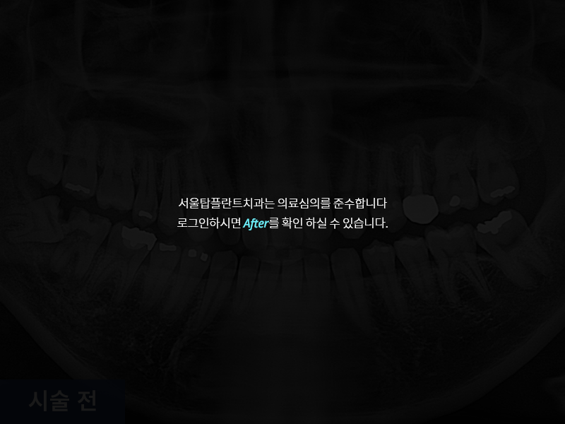 사랑니 발치 사례 2